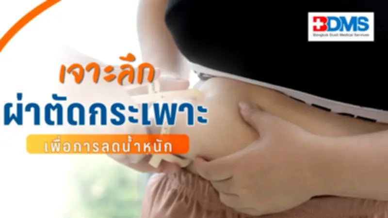 ผ่าตัดกระเพาะลดน้ำหนัก: ทางเลือกปลอดภัยสำหรับผู้ป่วยโรคอ้วน เปิดเกณฑ์ BMI และขั้นตอนการรักษา