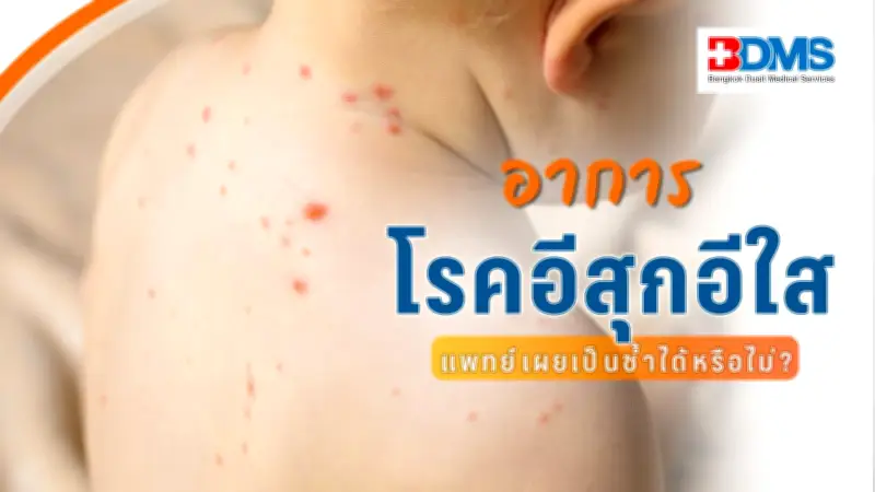 เตือนภัยโรคอีสุกอีใสระบาดหนัก เด็กป่วยมาก ผู้ใหญ่เสี่ยงอาการรุนแรงและภาวะแทรกซ้อน