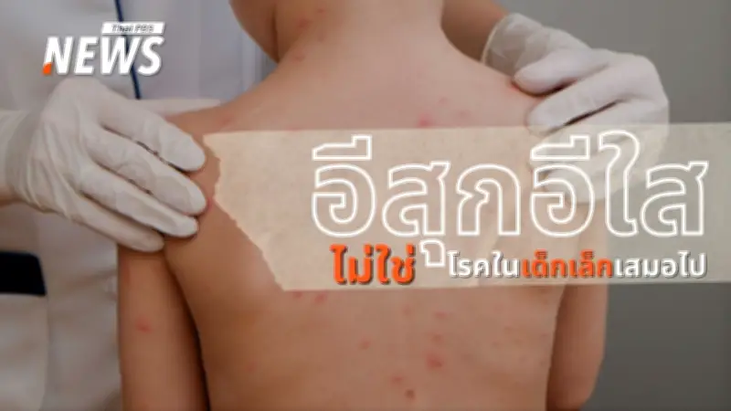 กรมควบคุมโรค-กทม.เตือนยอดผู้ป่วยอีสุกอีใสพุ่งเกินหมื่นราย เน้นกลุ่มเด็กวัยเรียน-มหาวิทยาลัย