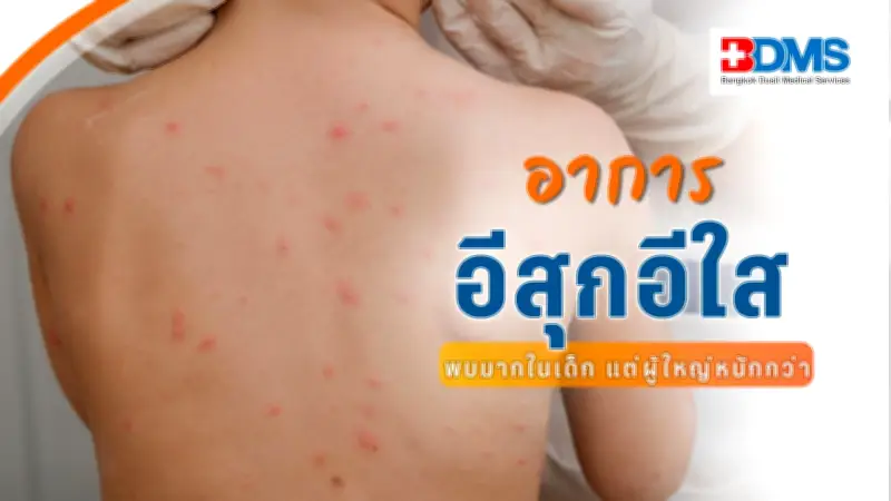 โรคอีสุกอีใส: ภัยเงียบในเด็กเล็ก เสี่ยงงูสวัดในอนาคต ป้องกันได้ด้วยวัคซีน