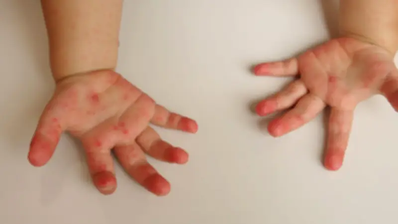 รู้จักเชื้อ EV71 ตัวร้ายในโรคมือเท้าปาก เสี่ยงสมองอักเสบ-หัวใจวาย พ่อแม่ต้องระวัง