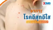เตือนภัยโรคอีสุกอีใสระบาดหนัก เด็กป่วยมาก ผู้ใหญ่เสี่ยงอาการรุนแรงและภาวะแทรกซ้อน
