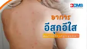 โรคอีสุกอีใส: ภัยเงียบในเด็กเล็ก เสี่ยงงูสวัดในอนาคต ป้องกันได้ด้วยวัคซีน