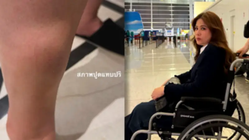 ติ๊ก กัญญารัตน์ เผยภาพขาบวมเหตุตกบันไดทริปเที่ยวญี่ปุ่น