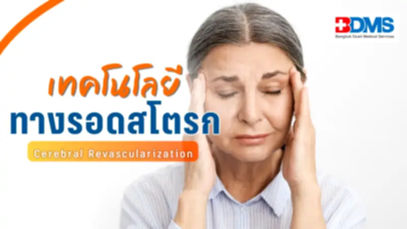 ผ่าตัดต่อเส้นเลือดสมอง Cerebral Revascularization ทางรอดผู้ป่วยสโตรก