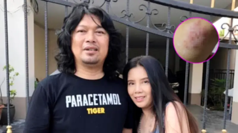แฟนคลับเป็นห่วง "กานต์ วิภากร" เผยภาพผื่นที่แขน "เสก โลโซ" หมอแนะวิธีรักษา