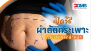 ผ่าตัดกระเพาะ 3 วิธีลดน้ำหนัก คุมเบาหวาน-ความดัน เสี่ยงโรคเรื้อรัง