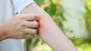 ยุงชอบกัดคนแบบไหน? เปิด 6 สาเหตุและวิธีรักษาอาการแพ้ยุงกัด