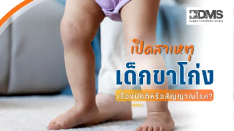 เด็กขาโก่งปกติหรือสัญญาณโรค? เช็กอาการเสี่ยงต้องรีบพบแพทย์