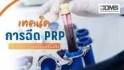 เทคนิคฉีด PRP ฟื้นฟูข้อ เอ็น กล้ามเนื้อ ด้วยเกล็ดเลือดตัวเอง ความปลอดภัยสูง