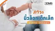 นิ้วล็อกในเด็กเล็ก: สัญญาณ สาเหตุ และวิธีรักษาที่พ่อแม่ควรรู้