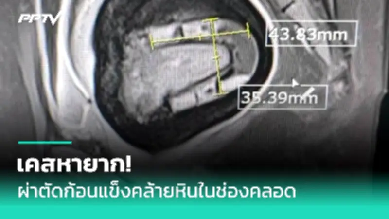สธ. เตือน 5 กลุ่มโรคระบาดหน้าฝน เสี่ยงไข้เลือดออก-ไข้หวัดใหญ่