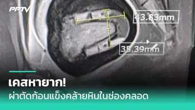 สธ. เตือน 5 กลุ่มโรคระบาดหน้าฝน เสี่ยงไข้เลือดออก-ไข้หวัดใหญ่